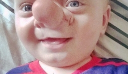 Lạ kỳ bé trai có não phát triển bên trong mũi