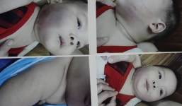 Bé 8 tháng tuổi nhập viện cấp cứu sau khi đi nhà trẻ về