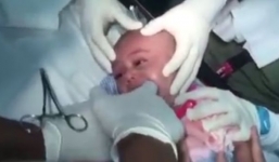 Video: Cận cảnh lấy pin đồng hồ trong họng bé sơ sinh