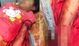 Nữ sinh bị 2 kẻ bịt mặt tấn công bằng dao nhọn trong đêm Noel