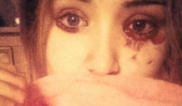 Mắc bệnh lạ cô gái chảy máu mắt năm lần một ngày