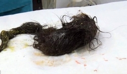 Phẫu thuật lấy búi tóc khổng lồ trong bụng bé gái