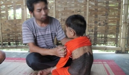 Nghệ An: Mắc bệnh lạ, bé gái mọc lông như 'người rừng'