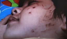 Bé gái 4 tuổi bị bạn học đánh hội đồng trong lớp