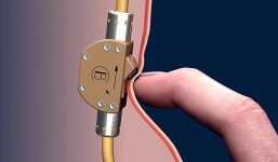 Thợ mộc Đức phát minh van khóa tinh trùng