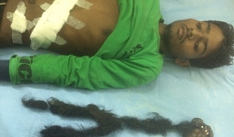 Hãi hùng với bào thai dị dạng 2,5kg trong bụng nam thanh niên