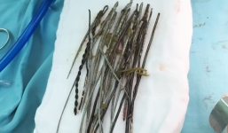 Huế: Cứu sống bệnh nhân ngáo đá nuốt 30 que sắt vào bụng