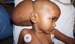 Bé gái có khối u to như quả bóng sau gáy được cứu sống