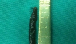 Phát hiện đỉa trâu trong mũi bé trai 2 tuổi