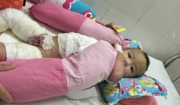 Xót thương bé một tuổi bỏng nặng do bị cả ấm nước sôi đổ lên người
