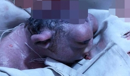 Bé sơ sinh có nửa đầu sống sót kỳ diệu trong 48 tiếng