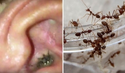 Hãi hùng hàng chục con kiến chui ra từ tai bé gái mỗi ngày