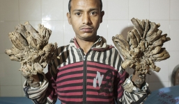 Dị nhân mắc bệnh lạ mọc 'rễ cây' khắp chân, tay