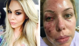 Cựu Hoa hậu Úc biến dạng khuôn mặt vì bị ném lựu đạn nổ