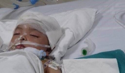Bé gái 3 tuổi bị vợt cầu lông đâm xuyên não, hôn mê tại chỗ