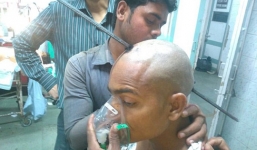 May mắn sống sót khi bị thanh sắt 2m xuyên qua đầu