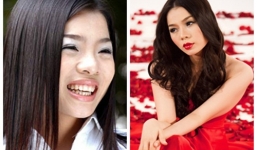 Lệ Quyên công khai từng phẫu thuật thẩm mỹ