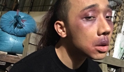 Trấn Thành bất ngờ bị đánh bầm dập mặt mũi