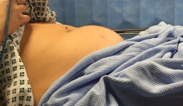 Nữ sinh suýt tử vong do quên băng vệ sinh trong cơ thể 9 ngày