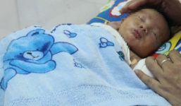 Bé sơ sinh bị dị tật ruột không có thần kinh hiếm gặp