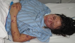 Ca nhiễm viêm não mô cầu ở Hà Nội: 27 người phải cách ly