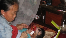 Người đàn ông mắc bệnh lạ 'ăn' mòn khuôn mặt ở Cà Mau