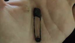 Phát hiện ghim băng dài 3,8 cm phân hủy trong mũi bé gái