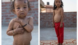 Cuộc sống của 2 chị em già nua, hom hem vì mắc bệnh lạ