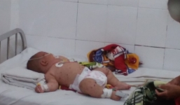 Đắk Lắk: Bé trai 5 tháng tuổi nghi nhiễm não mô cầu