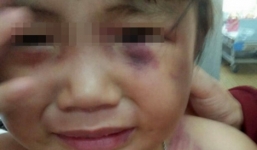 Nghi án bé gái 3 tuổi bị người tình của mẹ đánh bất tỉnh