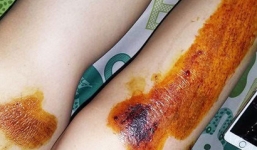 Á quân Giọng hát Việt Tố Ny bị cướp kéo lê trầy xước 2 chân