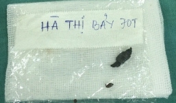 Phẫu thuật lấy 3 mảnh bom trong người bà cụ suốt 50 năm