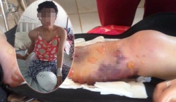 Bệnh viện phải bồi thường nữ sinh 15 tuổi bị cưa chân thế nào? 