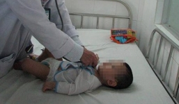 Phát hiện tụ điện tử trong phế quản bé 8 tháng tuổi