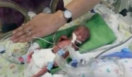  Diệu kỳ: Sinh ra chỉ bằng chiếc bút bi, bé gái vẫn sống khỏe mạnh