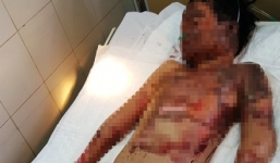 Nướng khoai bằng xăng, học sinh lớp 5 nguy kịch