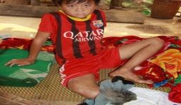 Cậu bé 12 tuổi 'xin cắt chân' đã được phẫu thuật