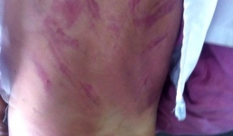 Bé gái 8 tuổi bị mẹ kế đánh đập dã man vì...1.000 đồng