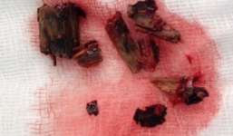 Cành cây đâm hốc mắt, mổ 8 lần mới lấy hết