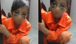 Cô giáo đánh học sinh tím mắt: Cơ quan chức năng đã vào cuộc