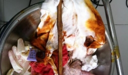 Cứu thành công bệnh nhân bị cọc đâm xuyên não