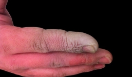 Những điều cần biết khi bị bỏng axit