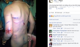 Vụ bé 7 tuổi bị cha dượng đánh tím người là thông tin chưa chuẩn xác