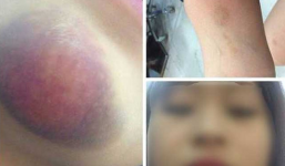 Thiếu nữ “tố” bị phụ xe buýt sàm sỡ, hành hung có được bồi thường?