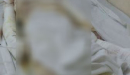 Để rơi tàn thuốc lá khi đang sửa xe, nam thanh niên bị bỏng toàn thân