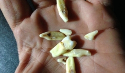 Nhận được tiền tỉ sau khi tự đập gãy răng của mình