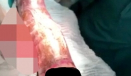 Mải 'tự sướng', củ sắn 50cm 'kẹt' trong hậu môn