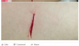 Thiếu nữ bị kẻ lạ mặt rạch đùi trong đêm