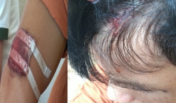 Bị đánh tại quán karaoke vì thắc mắc hóa đơn thanh toán