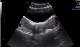 Hy hữu bé gái có 2 tử cung, 2 âm đạo, 1 quả thận